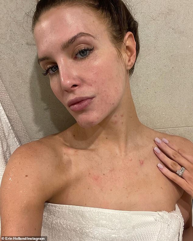 La ex Miss Mundo Australia, de 34 años, muestra su tez impecable después de sufrir acné quístico por someterse a una FIV con su esposo, el jugador de críquet, Ben Cutting.